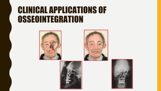 CLINICAL APPLICATIONS OF
OSSEOINTEGRATION
 