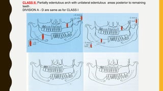 CLASS II: Partially edentulous arch with unilateral edentulous areas posterior to remaining
teeth .
DIVISION A - D are same as for CLASS I
 