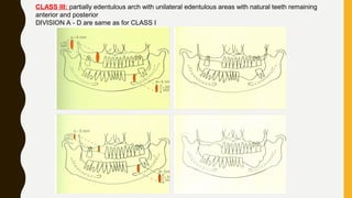 CLASS III: partially edentulous arch with unilateral edentulous areas with natural teeth remaining
anterior and posterior
DIVISION A - D are same as for CLASS I
 