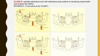 CLASS IV: partially edentulous arch with edentulous area anterior to remaining natural teeth
and crosses the midline
DIVISION A - D are same as for CLASS I
 