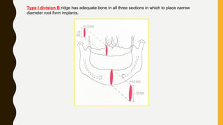 Type I division B ridge has adequate bone in all three sections in which to place narrow
diameter root form implants.
 