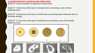 CLASSIFICATION BY LEKHOLM AND ZARB (1985):
QUALITY I bone comprises homogenous compact bone.
QUALITY II bone has a thick layer of compact bone surrounding a core of dense
trabecular bone.
QUALITY III bone has a thin layer of cortical bone surrounding dense trabecular bone of
favorable strength.
QUALITY IV bone has a thin layer of cortical bone surrounding a core of low density
trabecular bone.
 