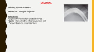 OCCLUSAL
Maxillary occlusal radiograph
Mandibular - orthognal projection
Limitations…
•Degree of mineralisation is not determined
•Spatial relationship b/w critical structures is lost
•Rarely indicated in implant dentistry
 