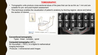 TOMOGRAPHY
• Tomographic units produce cross-sectional slices of the jaws that can be as thin as 1 mm and are
suitable for pre- and post-implant assessment
• This technique enables the visualization of patient’s anatomy by blurring regions above and below
the section of interest.
Conventional tomography :
Types : linear , complex , spiral
Computed tomography ( CT ) :
Sir Hounsfield ( 1972 ); is a digital & mathematical
imaging technique
Produces 3 dimensional axial images
 