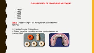 CLASSIFICATION OF PROSTHESIS MOVEMENT
• PM-O
• PM-2
• PM-3
• PM-4
• PM-6
PM-0 – prosthesis rigid – no movt (implant support similar
to FPD).
0-ring attachments (6 directions).
4 0-rings placed on complete arch and prosthesis rests on
the bar- PM-0
 