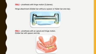 PM-2 – prosthesis with hinge motion (2 planes).
Hinge attachment (Dolder bar without a spacer or Hader bar and clip).
PM-3 – prosthesis with an apical and hinge motion.
Dolder bar with spacer and clip
 