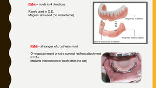 PM-4 – movts in 4 directions.
Rarely used in O.D.
Magnets are used.(no lateral force).
PM-6 – all ranges of prosthesis movt.
O-ring attachment or extra coronal resilient attachment
(ERA).
Implants independent of each other.(no bar)
 