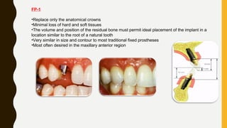 FP-1
•Replace only the anatomical crowns
•Minimal loss of hard and soft tissues
•The volume and position of the residual bone must permit ideal placement of the implant in a
location similar to the root of a natural tooth
•Very similar in size and contour to most traditional fixed prostheses
•Most often desired in the maxillary anterior region
 