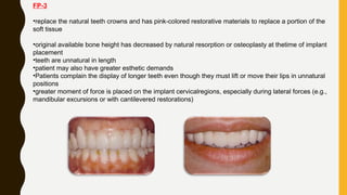 FP-3
•replace the natural teeth crowns and has pink-colored restorative materials to replace a portion of the
soft tissue
•original available bone height has decreased by natural resorption or osteoplasty at thetime of implant
placement
•teeth are unnatural in length
•patient may also have greater esthetic demands
•Patients complain the display of longer teeth even though they must lift or move their lips in unnatural
positions
•greater moment of force is placed on the implant cervicalregions, especially during lateral forces (e.g.,
mandibular excursions or with cantilevered restorations)
 