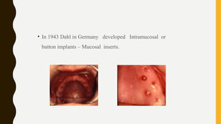• In 1943 Dahl in Germany developed Intramucosal or
button implants – Mucosal inserts.
 