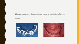 • Linkow developed Sub periosteal implant consisting of three
islands
 