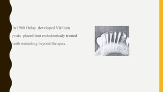• In 1960 Onlay developed Virilium
posts placed into endodonticaly treated
teeth extending beyond the apex.
 