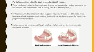 • Partial edentulism with the back (posterior) tooth missing
These conditions imply the absence of several posterior teeth (molars and/or premolars) on
one or both sides of the dental arch (Kennedy class 1 or Kennedy class 2).
In these cases, traditional dental bridges (supported by natural teeth) are difficult to design
because the back support tooth is missing. Removable partial dentures generally require the
preparation of more teeth.
Implant supported prostheses, although entailing a higher cost, are the most adequate
therapeutic solutions
 