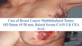 Breast Cancer & Homoeopathy