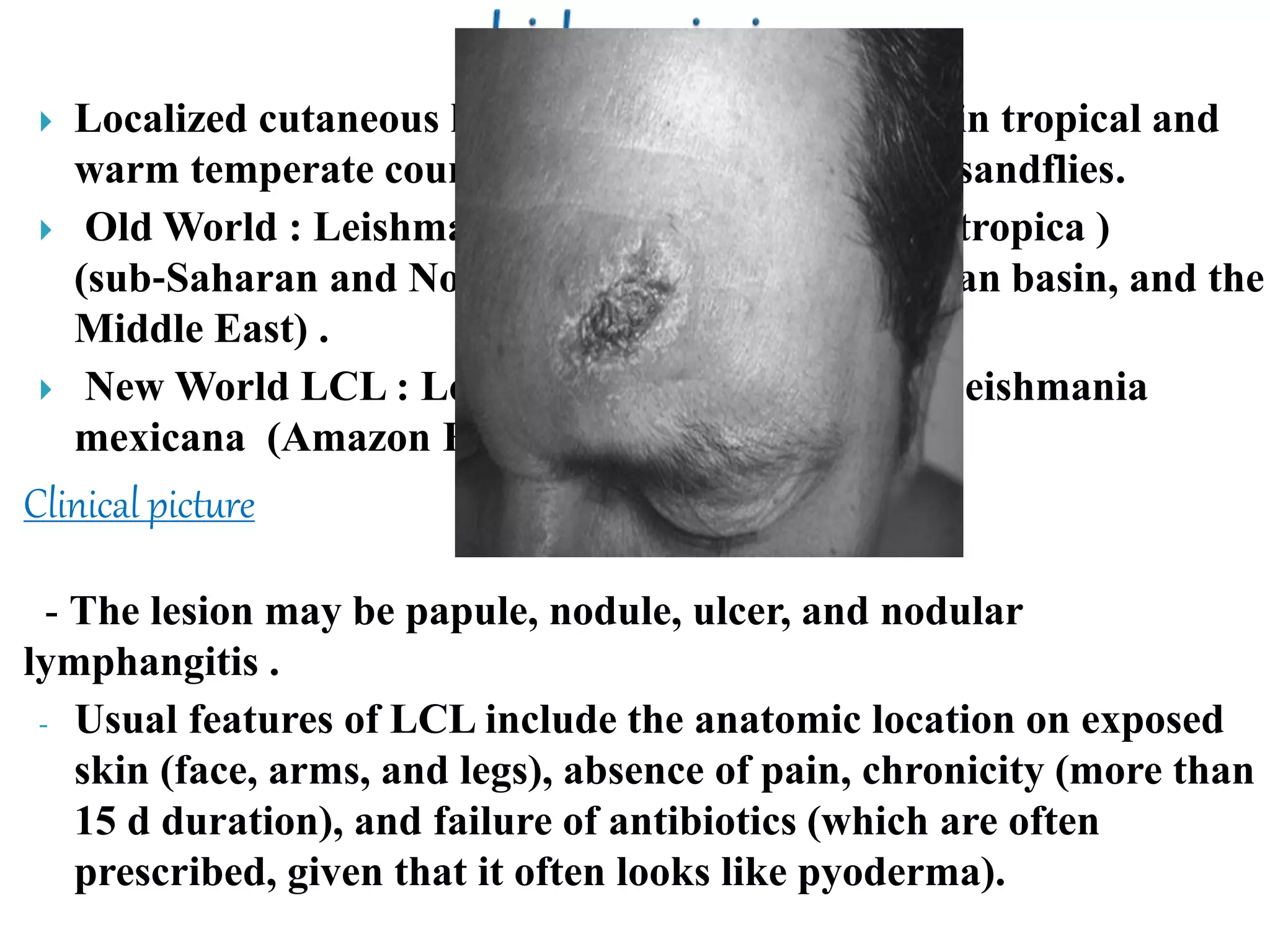  Localized cutaneous leishmaniasis (LCL) occurs in tropical and
warm temperate countries and is transmitted by sandflies.
 Old World : Leishmania major and Leishmania tropica )
(sub‐Saharan and North Africa, the Mediterranean basin, and the
Middle East) .
 New World LCL : Leishmania braziliensis and Leishmania
mexicana (Amazon Forest of South America) .
- The lesion may be papule, nodule, ulcer, and nodular
lymphangitis .
- Usual features of LCL include the anatomic location on exposed
skin (face, arms, and legs), absence of pain, chronicity (more than
15 d duration), and failure of antibiotics (which are often
prescribed, given that it often looks like pyoderma).
Clinical picture
 