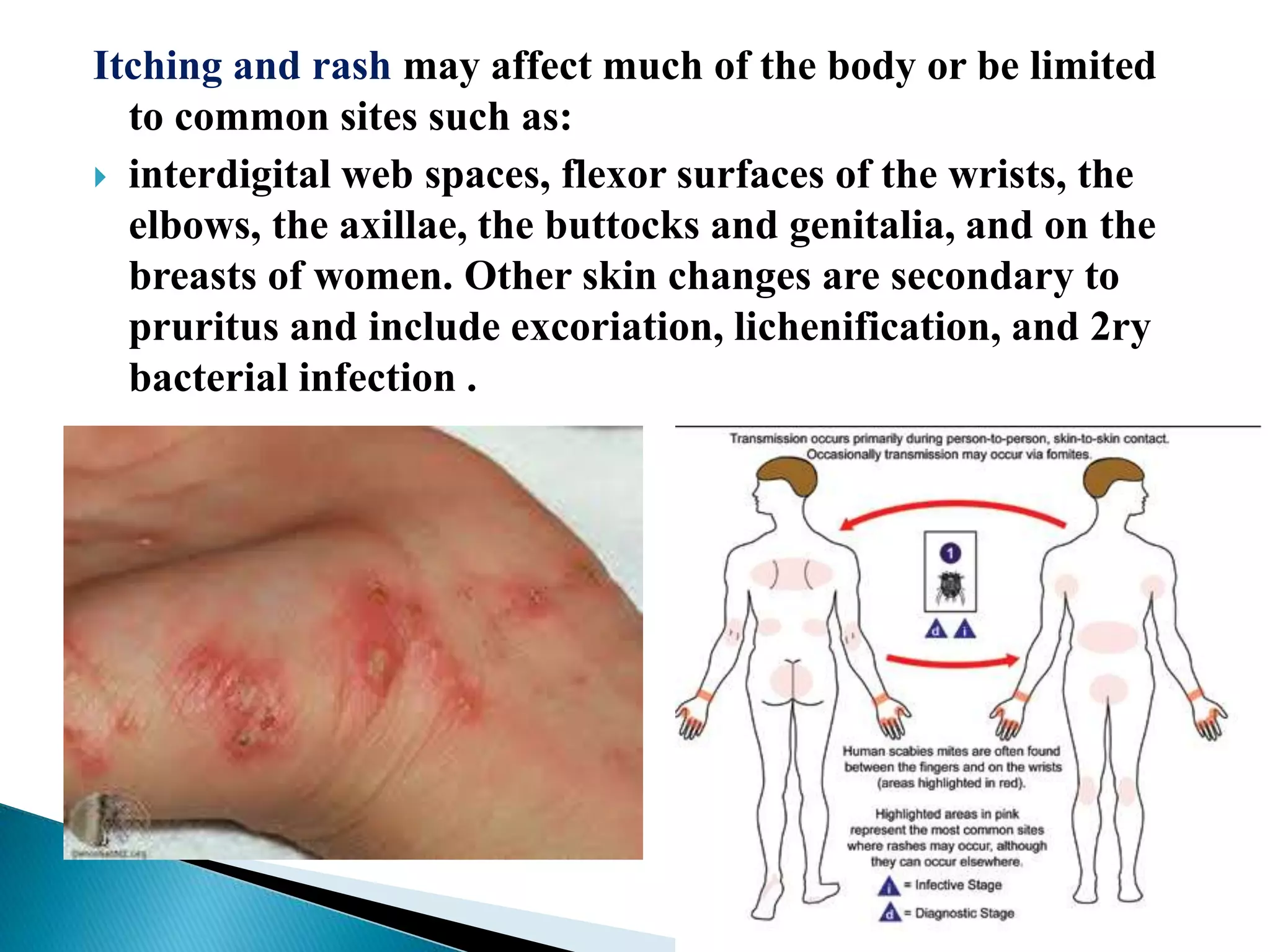 Itching and rash may affect much of the body or be limited
to common sites such as:
 interdigital web spaces, flexor surfaces of the wrists, the
elbows, the axillae, the buttocks and genitalia, and on the
breasts of women. Other skin changes are secondary to
pruritus and include excoriation, lichenification, and 2ry
bacterial infection .
 