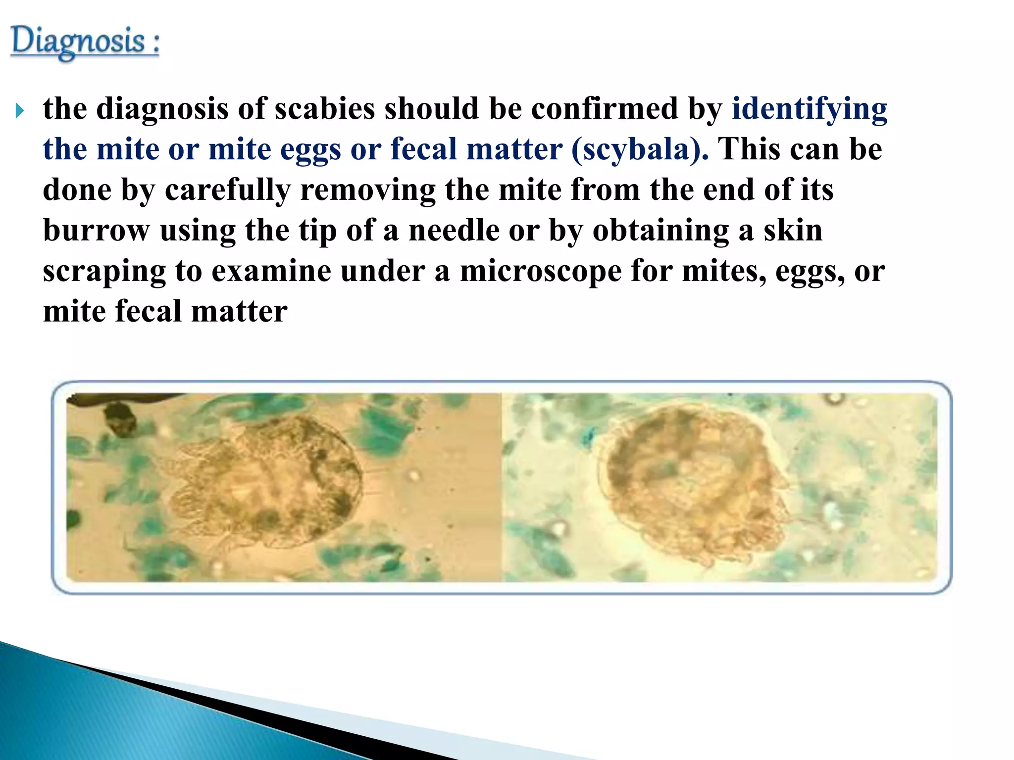  the diagnosis of scabies should be confirmed by identifying
the mite or mite eggs or fecal matter (scybala). This can be
done by carefully removing the mite from the end of its
burrow using the tip of a needle or by obtaining a skin
scraping to examine under a microscope for mites, eggs, or
mite fecal matter
 