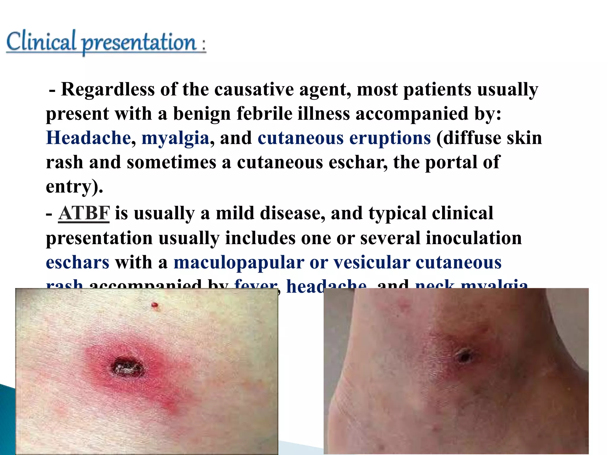 - Regardless of the causative agent, most patients usually
present with a benign febrile illness accompanied by:
Headache, myalgia, and cutaneous eruptions (diffuse skin
rash and sometimes a cutaneous eschar, the portal of
entry).
- ATBF is usually a mild disease, and typical clinical
presentation usually includes one or several inoculation
eschars with a maculopapular or vesicular cutaneous
rash accompanied by fever, headache, and neck myalgia .
 