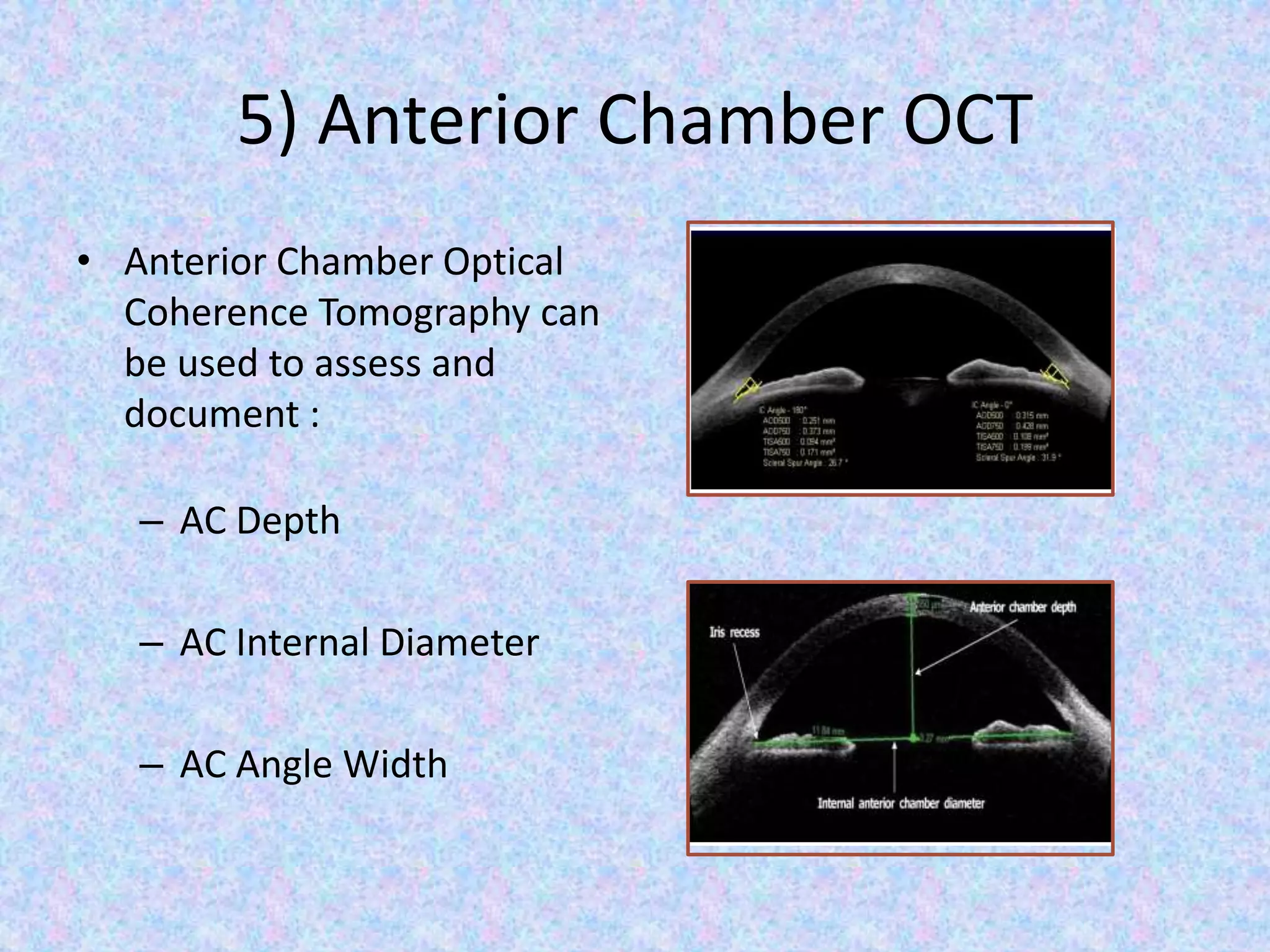 5) Anterior Chamber OCT
• Anterior Chamber Optical
Coherence Tomography can
be used to assess and
document :
– AC Depth
– AC Internal Diameter
– AC Angle Width
 