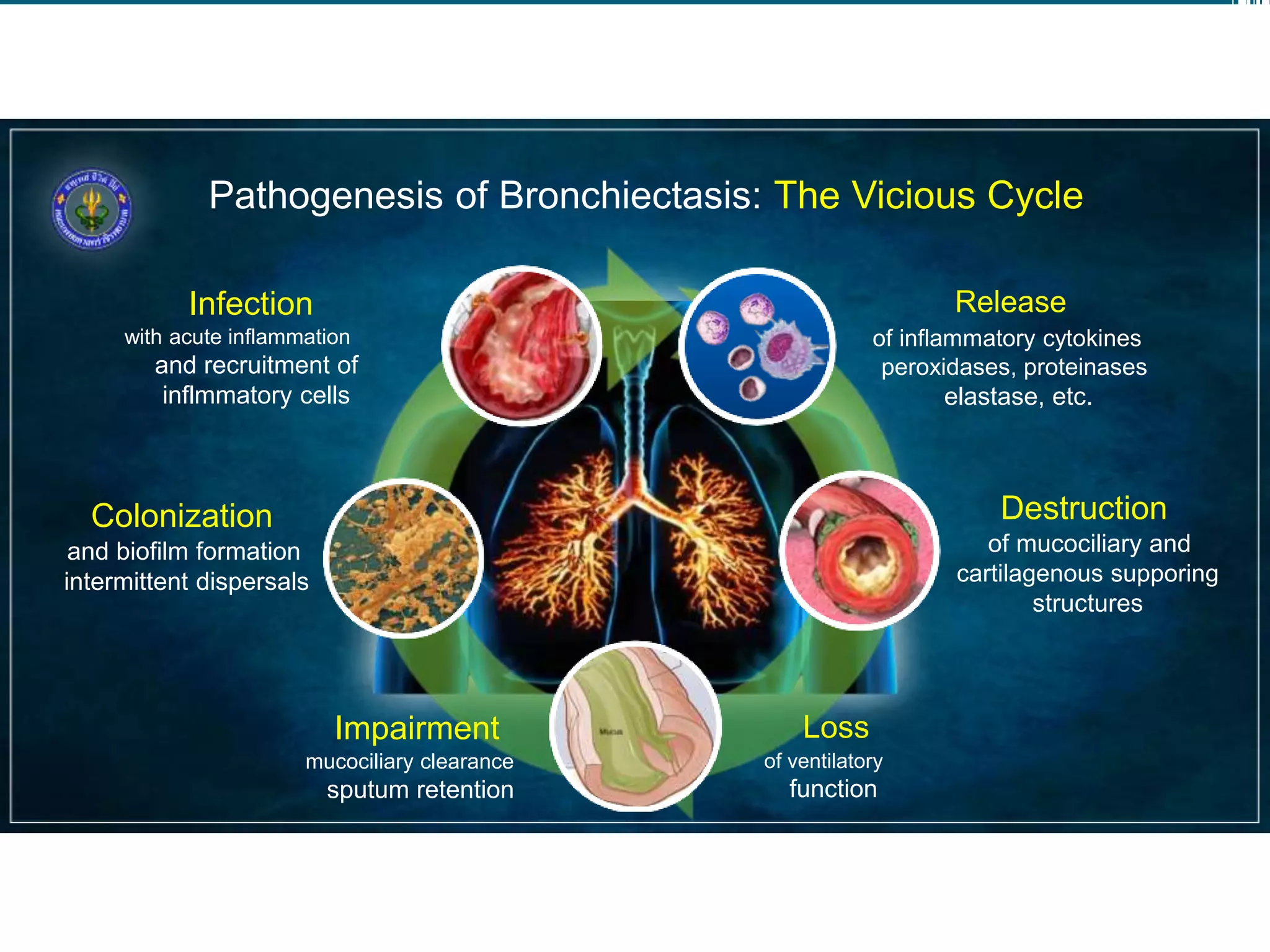 Pathogenesis of Bronchiectasis: The Vicious Cycle
Destruction
of mucociliary and
cartilagenous supporing
structures
Release
of inflammatory cytokines
peroxidases, proteinases
elastase, etc.
Colonization
and biofilm formation
intermittent dispersals
Infection
with acute inflammation
and recruitment of
inflmmatory cells
Impairment
mucociliary clearance
sputum retention
Loss
of ventilatory
function
 