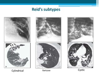 Reid’s subtypes
CysticCylindrical Varicose
 