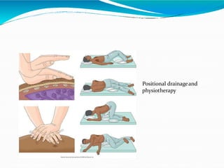 Positional drainageand
physiotherapy
 