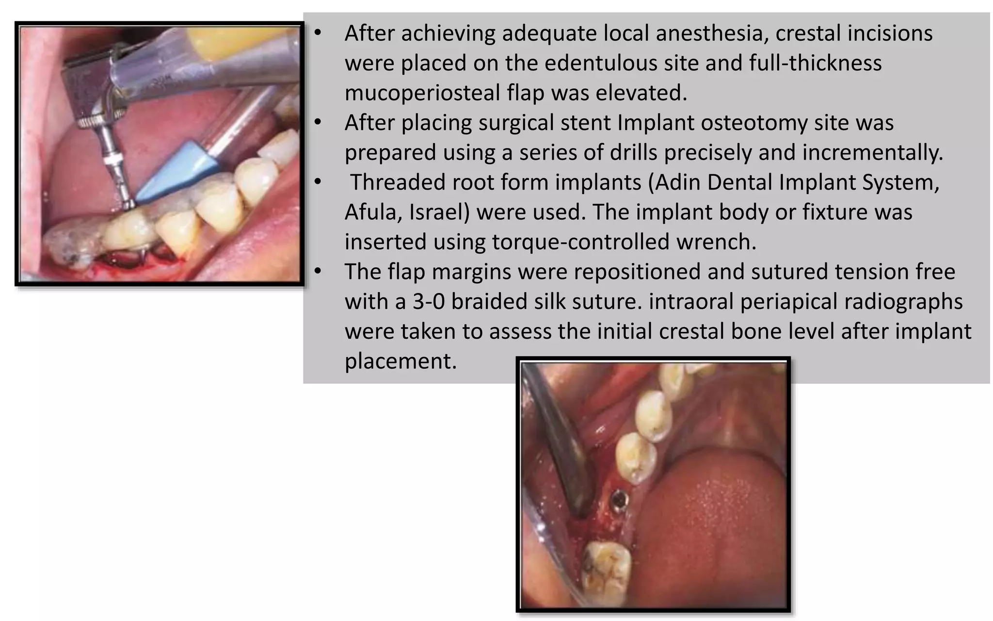 • After achieving adequate local anesthesia, crestal incisions
were placed on the edentulous site and full-thickness
mucoperiosteal flap was elevated.
• After placing surgical stent Implant osteotomy site was
prepared using a series of drills precisely and incrementally.
• Threaded root form implants (Adin Dental Implant System,
Afula, Israel) were used. The implant body or fixture was
inserted using torque-controlled wrench.
• The flap margins were repositioned and sutured tension free
with a 3-0 braided silk suture. intraoral periapical radiographs
were taken to assess the initial crestal bone level after implant
placement.
 
