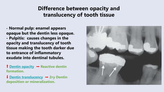 Translucent Dentin X-rays uses and benefits in endodontic treatment | PPTX