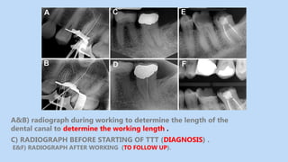 Endo Short Working Length Radiograph X-rays uses and benefits in endodontic treatment | PPTX