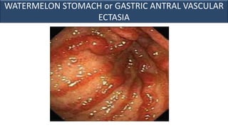 WATERMELON STOMACH or GASTRIC ANTRAL VASCULAR
ECTASIA
 