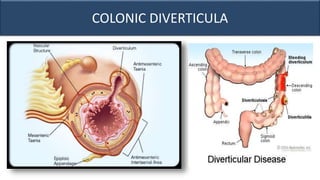 COLONIC DIVERTICULA
 