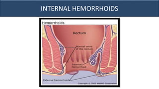 INTERNAL HEMORRHOIDS
 