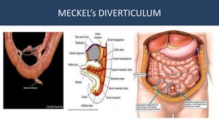 MECKEL’s DIVERTICULUM
 