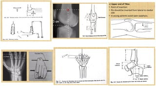 Comprehensive Guide to Traction and Splints in Orthopedic Care | PDF