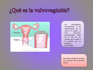 Las vulvovaginitis
corresponden a las
inflamaciones de la
vulva y la vagina, es
muy frecuente,
presentándose hasta
en el 25% de las
mujeres que acuden a
la consulta por un
problema
ginecológico.
Aumenta el riesgo de contraer
una infección de transmisión
sexual.
 