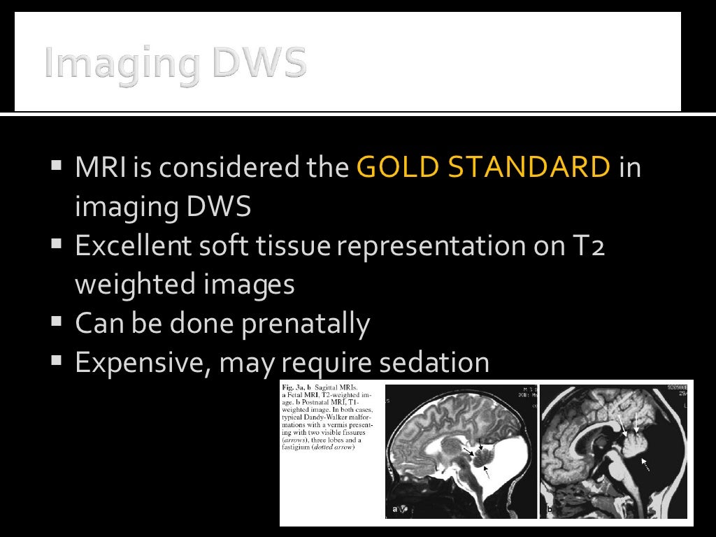 CT Dandy Walker Syndrome