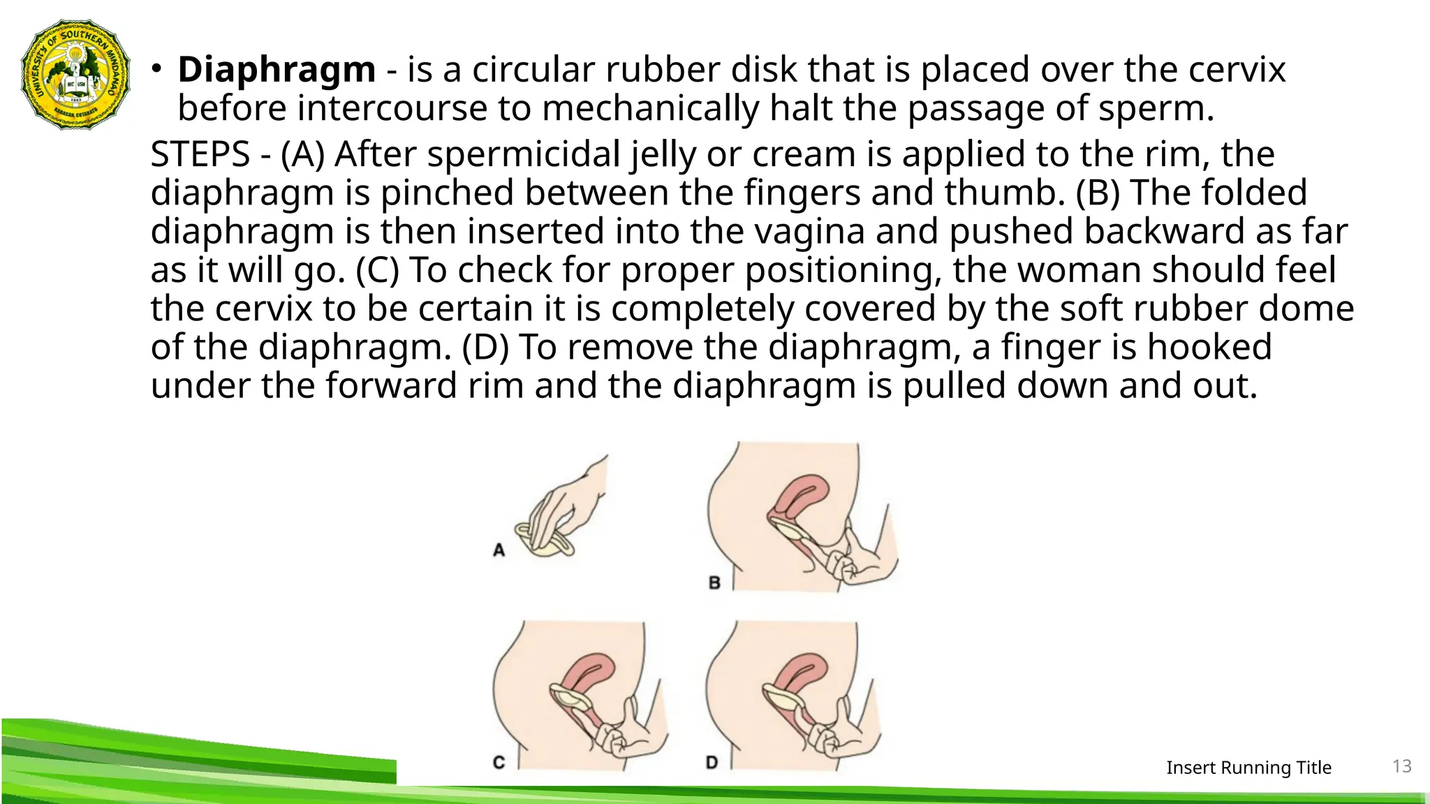 • Diaphragm - is a circular rubber disk that is placed over the cervix
before intercourse to mechanically halt the passage of sperm.
STEPS - (A) After spermicidal jelly or cream is applied to the rim, the
diaphragm is pinched between the fingers and thumb. (B) The folded
diaphragm is then inserted into the vagina and pushed backward as far
as it will go. (C) To check for proper positioning, the woman should feel
the cervix to be certain it is completely covered by the soft rubber dome
of the diaphragm. (D) To remove the diaphragm, a finger is hooked
under the forward rim and the diaphragm is pulled down and out.
Insert Running Title 13
 