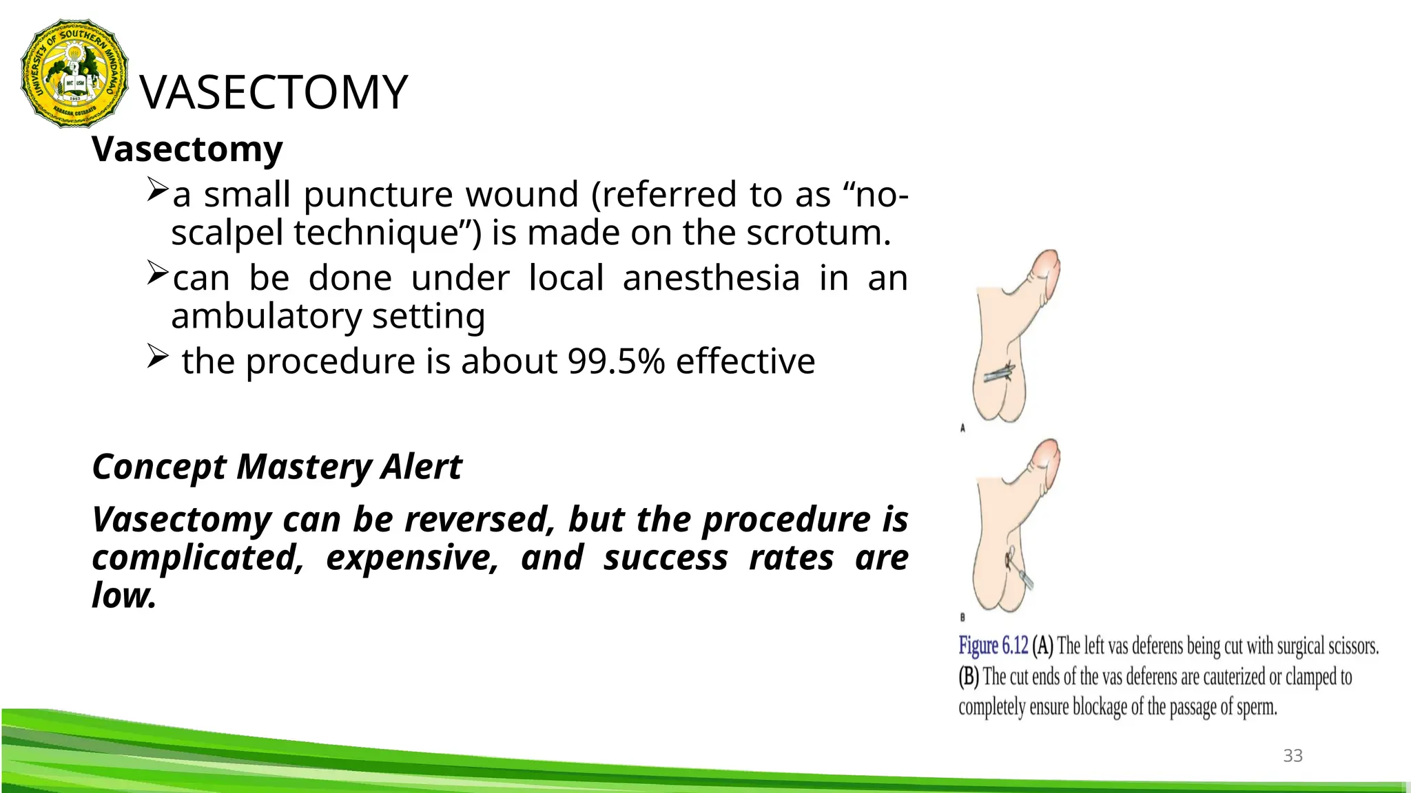 33
Vasectomy
a small puncture wound (referred to as “no-
scalpel technique”) is made on the scrotum.
can be done under local anesthesia in an
ambulatory setting
 the procedure is about 99.5% effective
Concept Mastery Alert
Vasectomy can be reversed, but the procedure is
complicated, expensive, and success rates are
low.
VASECTOMY
 