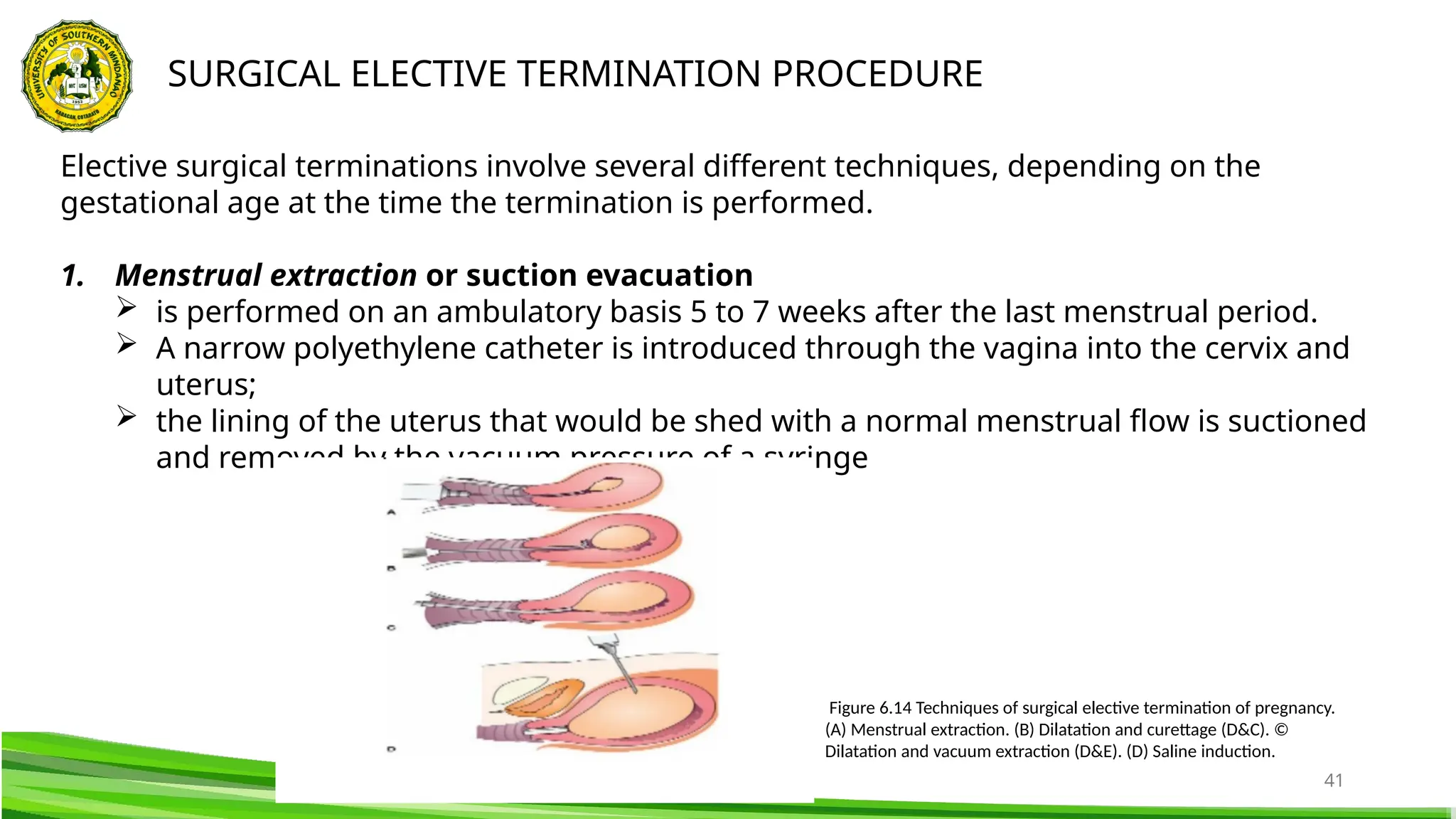 41
SURGICAL ELECTIVE TERMINATION PROCEDURE
Figure 6.14 Techniques of surgical elective termination of pregnancy.
(A) Menstrual extraction. (B) Dilatation and curettage (D&C). ©
Dilatation and vacuum extraction (D&E). (D) Saline induction.
Elective surgical terminations involve several different techniques, depending on the
gestational age at the time the termination is performed.
1. Menstrual extraction or suction evacuation
 is performed on an ambulatory basis 5 to 7 weeks after the last menstrual period.
 A narrow polyethylene catheter is introduced through the vagina into the cervix and
uterus;
 the lining of the uterus that would be shed with a normal menstrual flow is suctioned
and removed by the vacuum pressure of a syringe
 