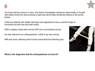 An 8 year old boy came to a clinic, the doctor immediately noticed an abnormality in his gait
(left sided) where the stance phase of gait was abnormally shortened relative to the swing
phase.
Child was afebrile with stable vital signs and appeared to have a painful range of
movement at both hips and both knees.
ESR is slightly raised with normal CRP and normal blood counts.
He was referred to an orthopaedician. Initial X ray was normal.
MRI was done, following which doctor prescribed the following cast.
What is the diagnosis that the orthopaedician arrived at?
6
 