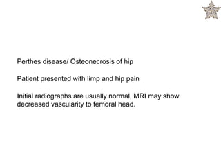 Perthes disease/ Osteonecrosis of hip
Patient presented with limp and hip pain
Initial radiographs are usually normal, MRI may show
decreased vascularity to femoral head.
 