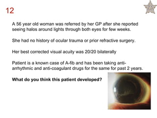 A 56 year old woman was referred by her GP after she reported
seeing halos around lights through both eyes for few weeks.
She had no history of ocular trauma or prior refractive surgery.
Her best corrected visual acuity was 20/20 bilaterally
Patient is a known case of A-fib and has been taking anti-
arrhythmic and anti-coagulant drugs for the same for past 2 years.
What do you think this patient developed?
12
 