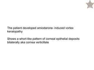 The patient developed amiodarone- induced vortex
keratopathy
Shows a whorl-like pattern of corneal epithelial deposits
bilaterally aka cornea verticillate
 