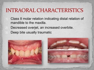 1) Class II molar relation indicating distal relation of
mandible to the maxilla.
2) Decreased overjet, an increased overbite.
3) Deep bite usually traumatic
 