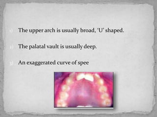 1) The upper arch is usually broad, ‘U’ shaped.
2) The palatal vault is usually deep.
3) An exaggerated curve of spee
 