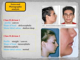 Extra-oral
Photographic
analysis
Class II divison 1
profile: convex
Shape of head : dolicocephalic
Mento labial sulcus : shallow/deep
Class II divison 2
Profile : straight / convex
Shape of head : mesocephalic
/dolichocephalic
Mento labial sulcus : normal
 