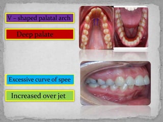 V – shaped palatal arch
Excessive curve of spee
Deep palate
Increased over jet
 