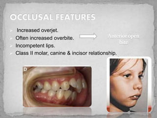  Increased overjet.
 Often increased overbite.
 Incompetent lips.
 Class II molar, canine & incisor relationship.
 