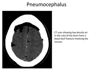 Pneumocranium Radiograph uses and indication of radiology in surgery | PPTX