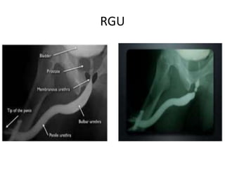 Utricular Cyst Rgu uses and indication of radiology in surgery | PPTX